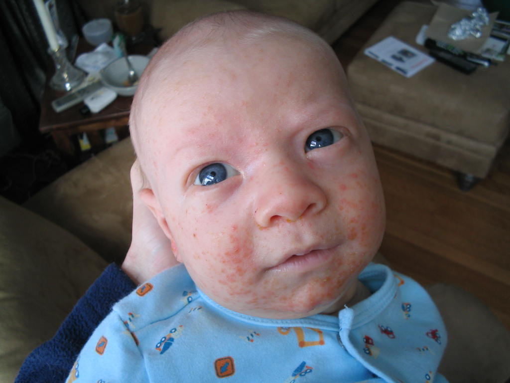 Infant Acne, a case study